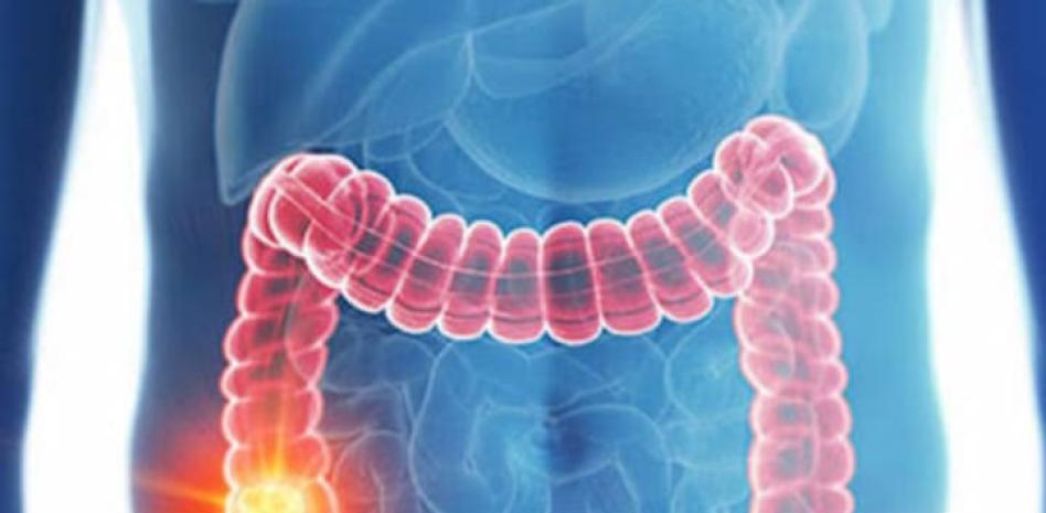Cáncer colorrectal: molestias abdominales, uno de sus principales síntomas